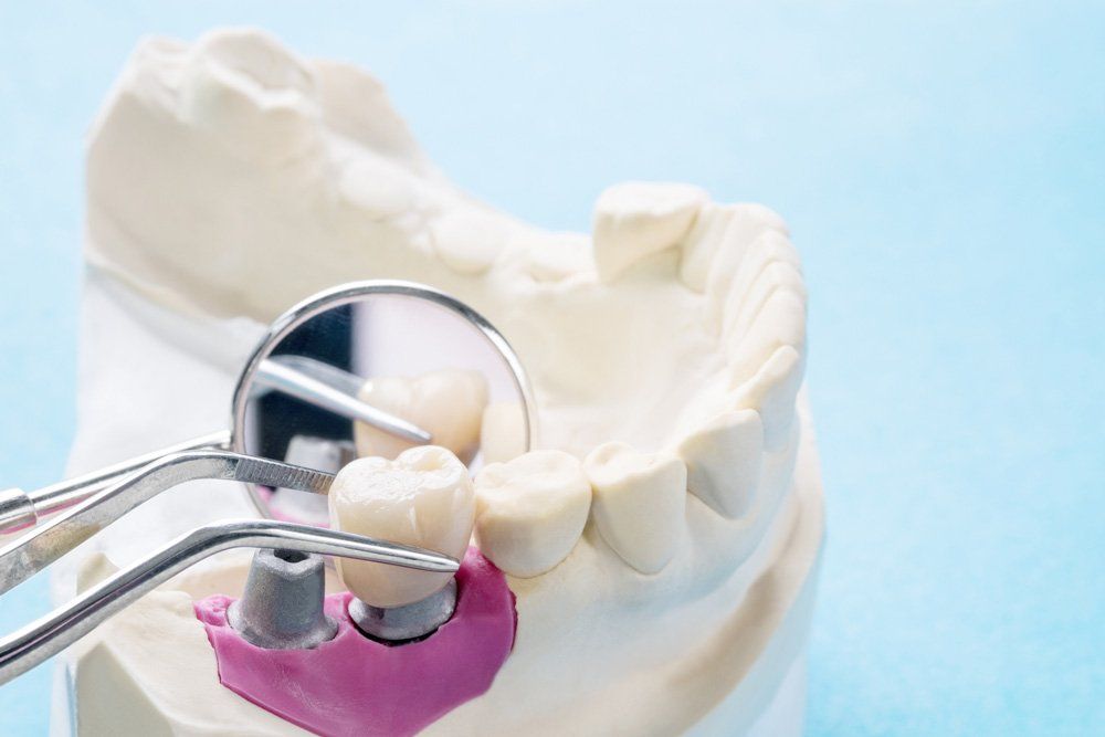 Dental Implant — Sandusky, Ohio — North Coast Oral & Maxillofacial Surgery Dental Implant — Sandusky, Ohio — North Coast Oral & Maxillofacial Surgery