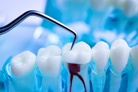 Root Canal Treatment