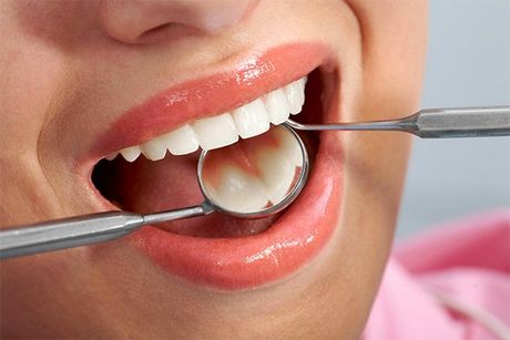 Tooth- Colored Fillings