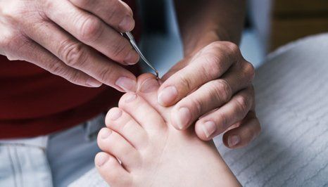 ingrown toenail removal