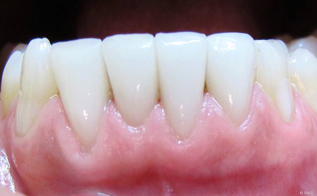Veneers der unteren vier Schneidezähne bei einer Raucherin vier Jahre nach dem Einsetzen: Es sind keinerlei Verfärbungen sichtbar. Veneers der unteren vier Schneidezähne bei einer Raucherin vier Jahre nach dem Einsetzen: Es sind keinerlei Verfärbungen sichtbar.
