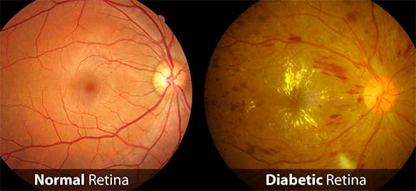 Side-by-side retinal images labeled normal retina and diabetic retina, showing healthy and damaged blood vessels.
