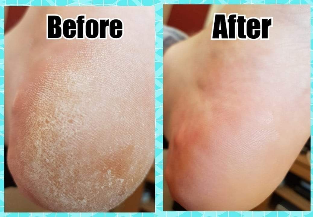 Marske podiatrist callus removal