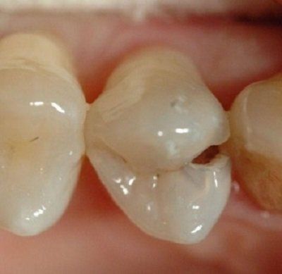 dente cariato