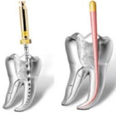 intervento di endodonzia