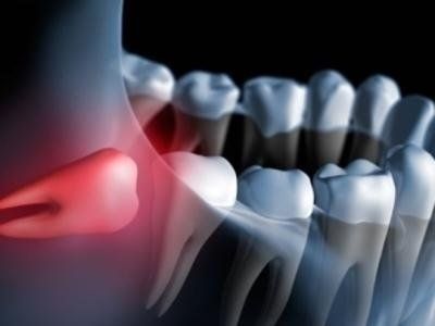 scorretto posizionamento dei denti