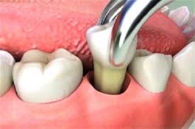 estrazione di un dente