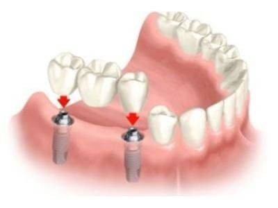impianto dentale con utilizzo di viti