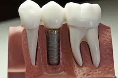 impianto dentale con vite in sede