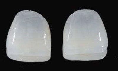 faccette denti