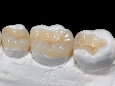 intarsi dentali