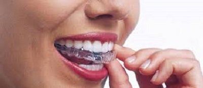 bocca con apparecchio ortodontico mobile invisibile