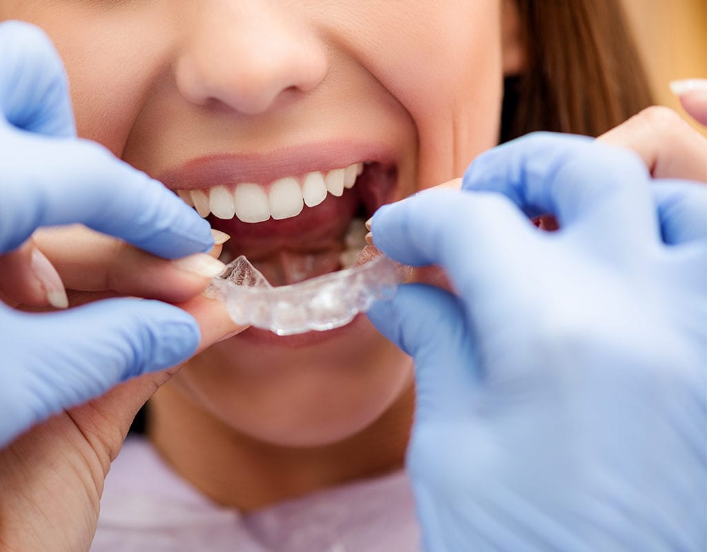 DENTAL IMPLANTS