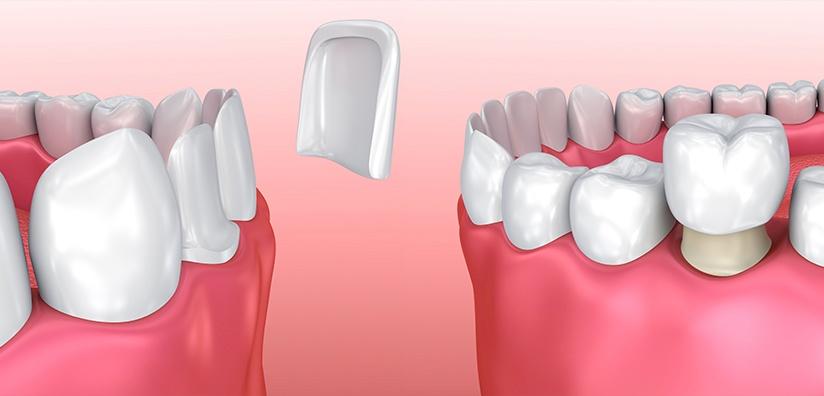 teeth whitening brooklyn