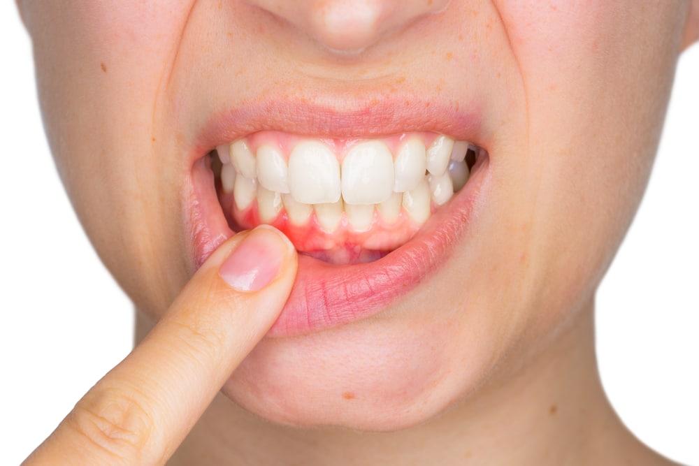 DENTAL IMPLANTS