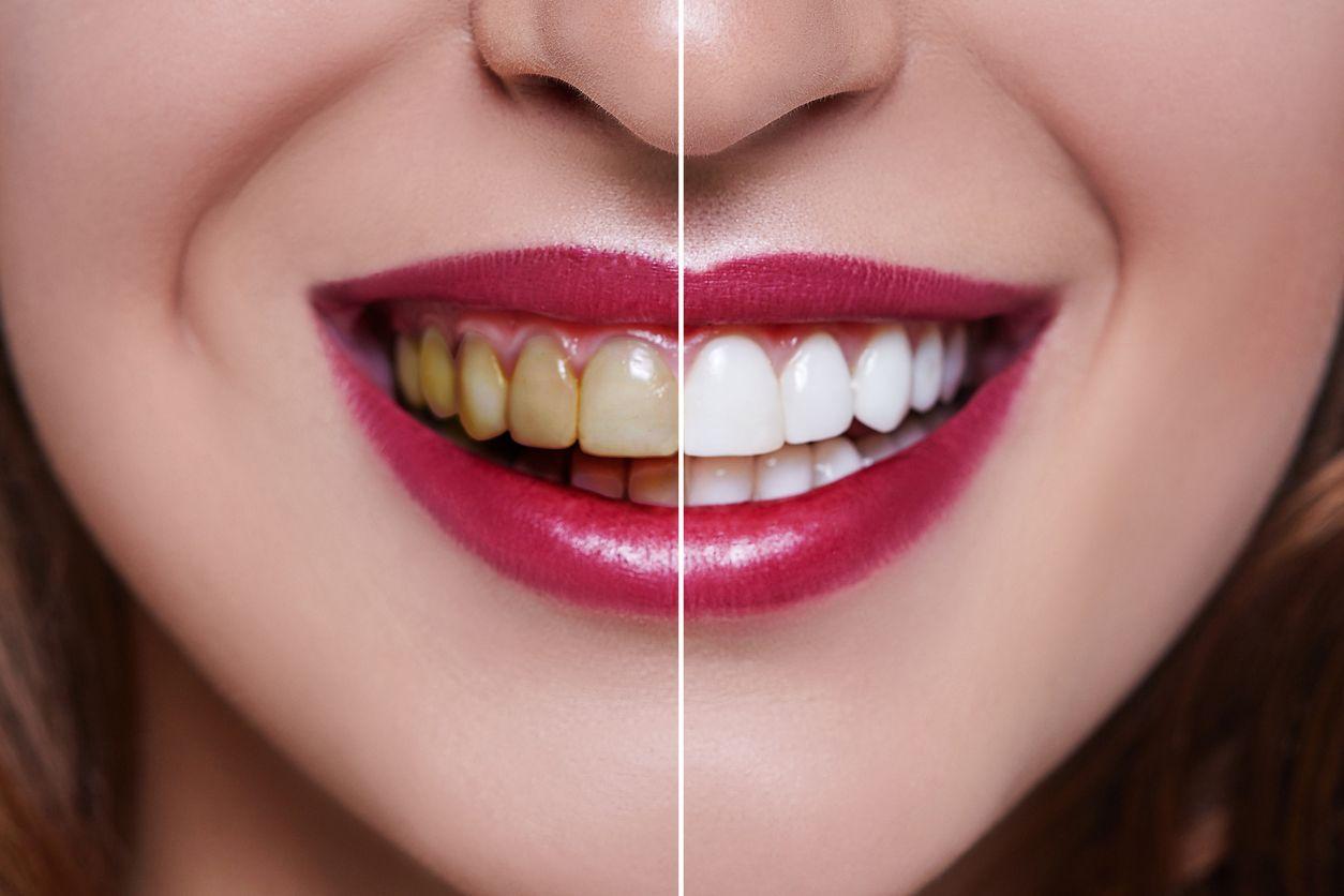 teeth whitening brooklyn