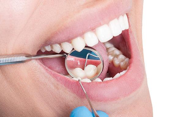 DENTAL IMPLANTS