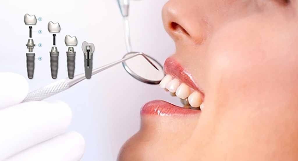 DENTAL IMPLANTS