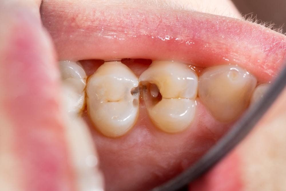 teeth whitening brooklyn
