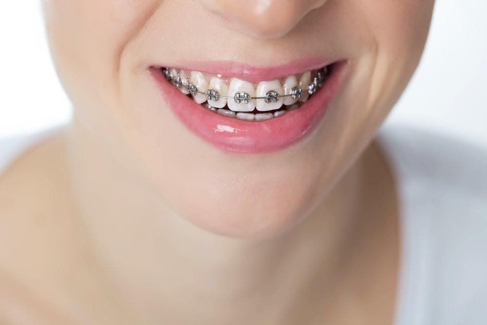 teeth whitening brooklyn