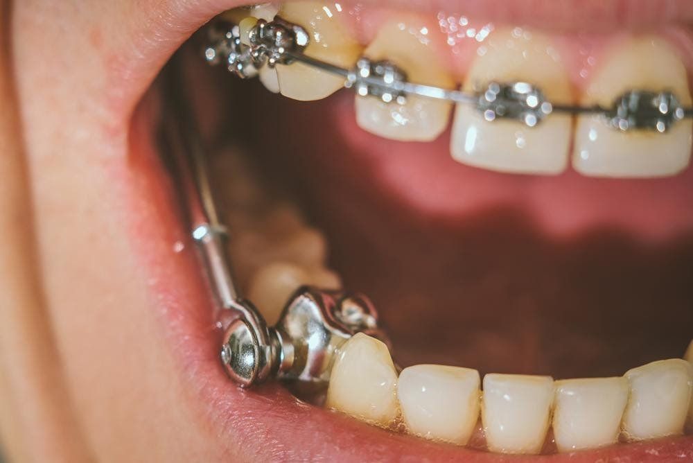 DENTAL IMPLANTS