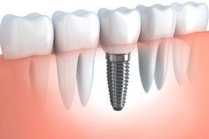 DENTAL IMPLANTS