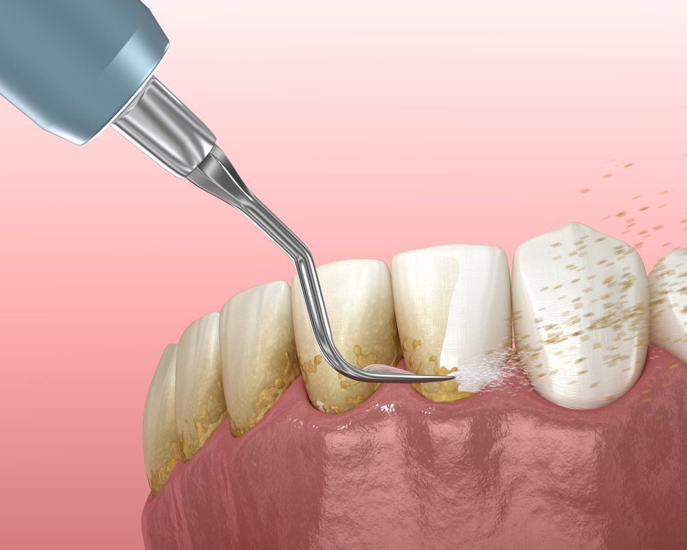 dental implants brooklyn