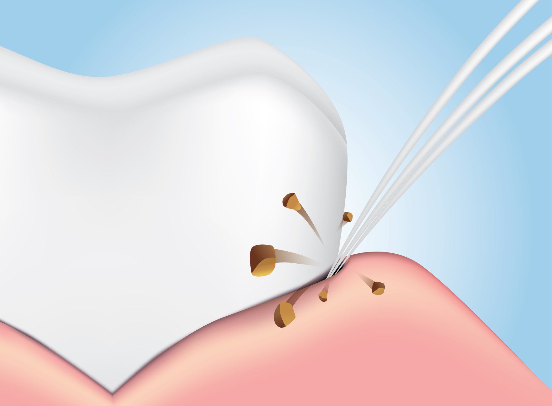 dental implants brooklyn