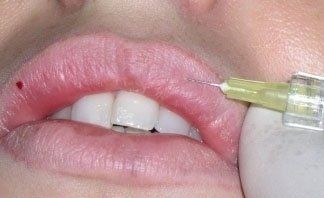 Filler alle labbra