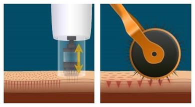 Illustrazione del microneedling