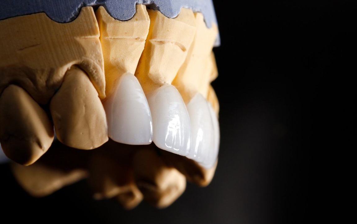 Prima e dopo sbiancamento dentale