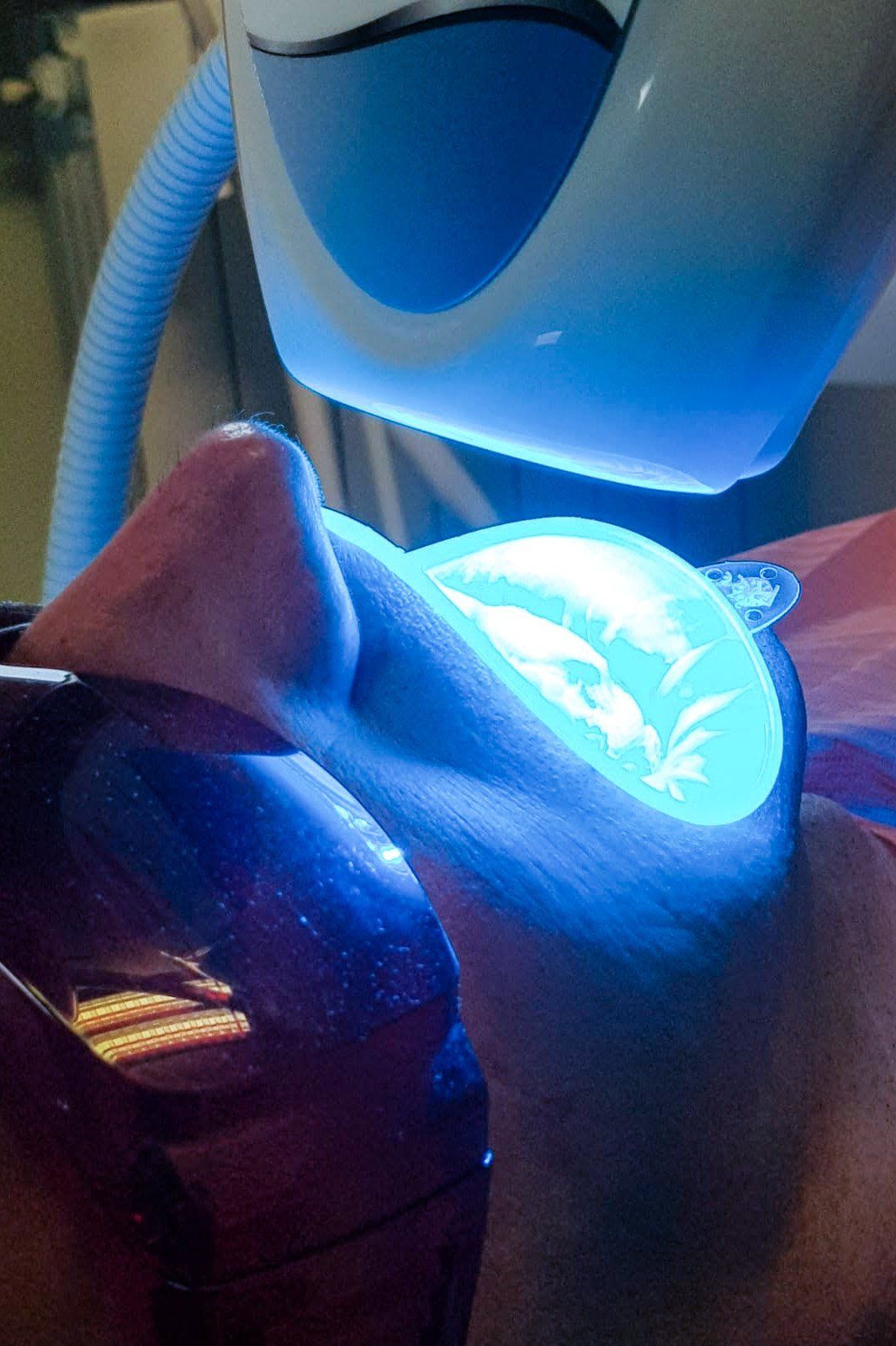 Sbiancamento denti con mascherina
