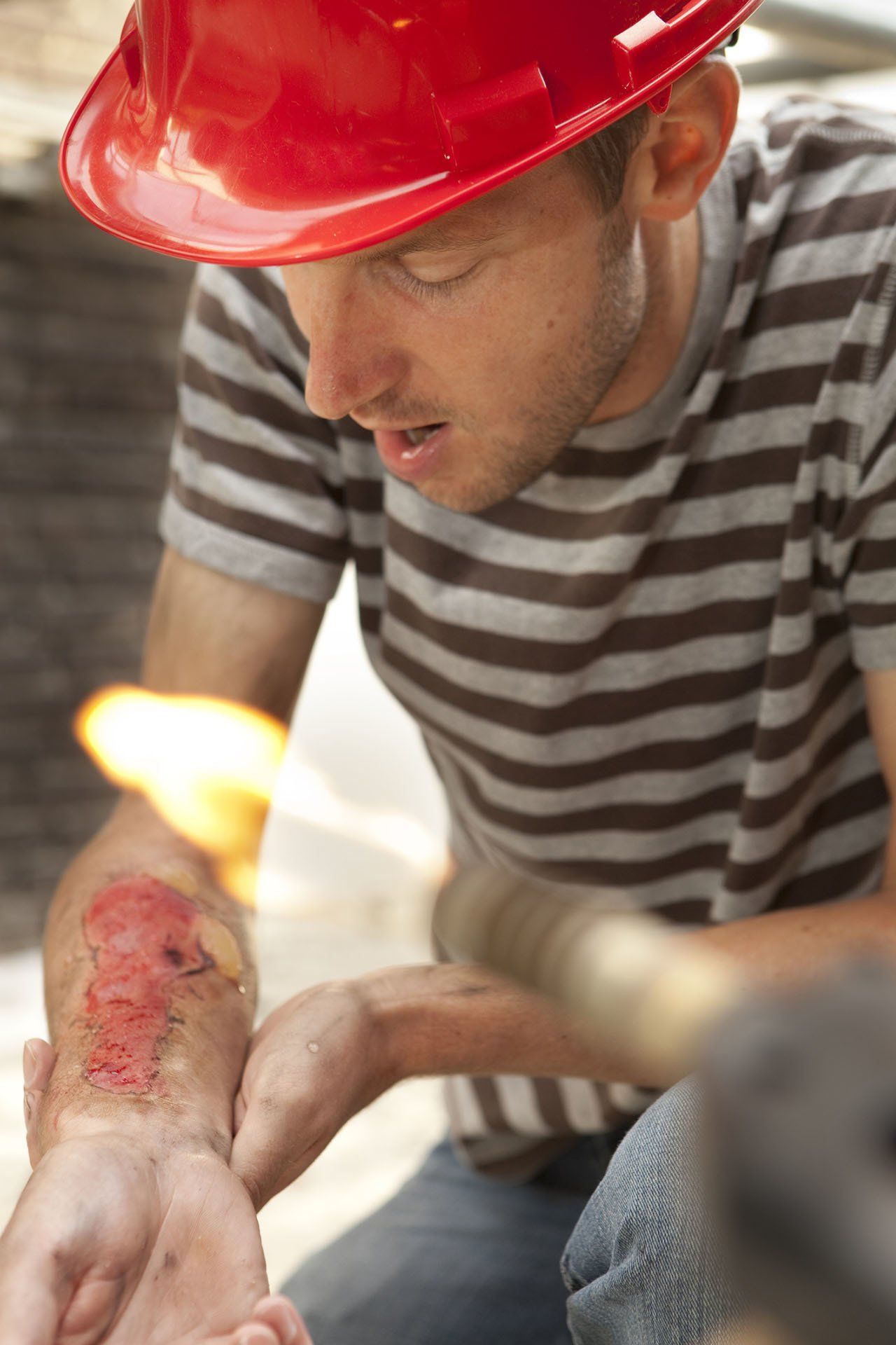 Burn Injury At Work — Charleston, WV — Cormany Law PLLC