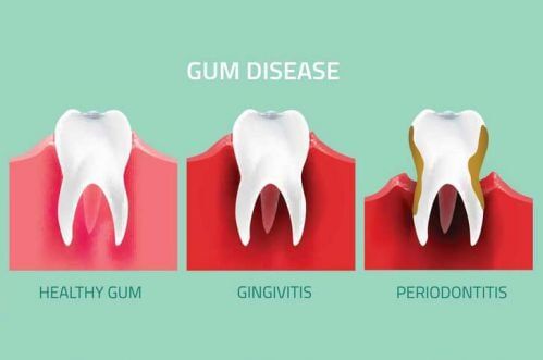 Dentures — Dentures & Dental Implants in Bend, OR Dentures — Dentures & Dental Implants in Bend, OR