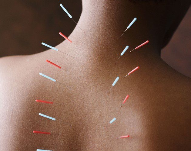 Acupuncture treatment