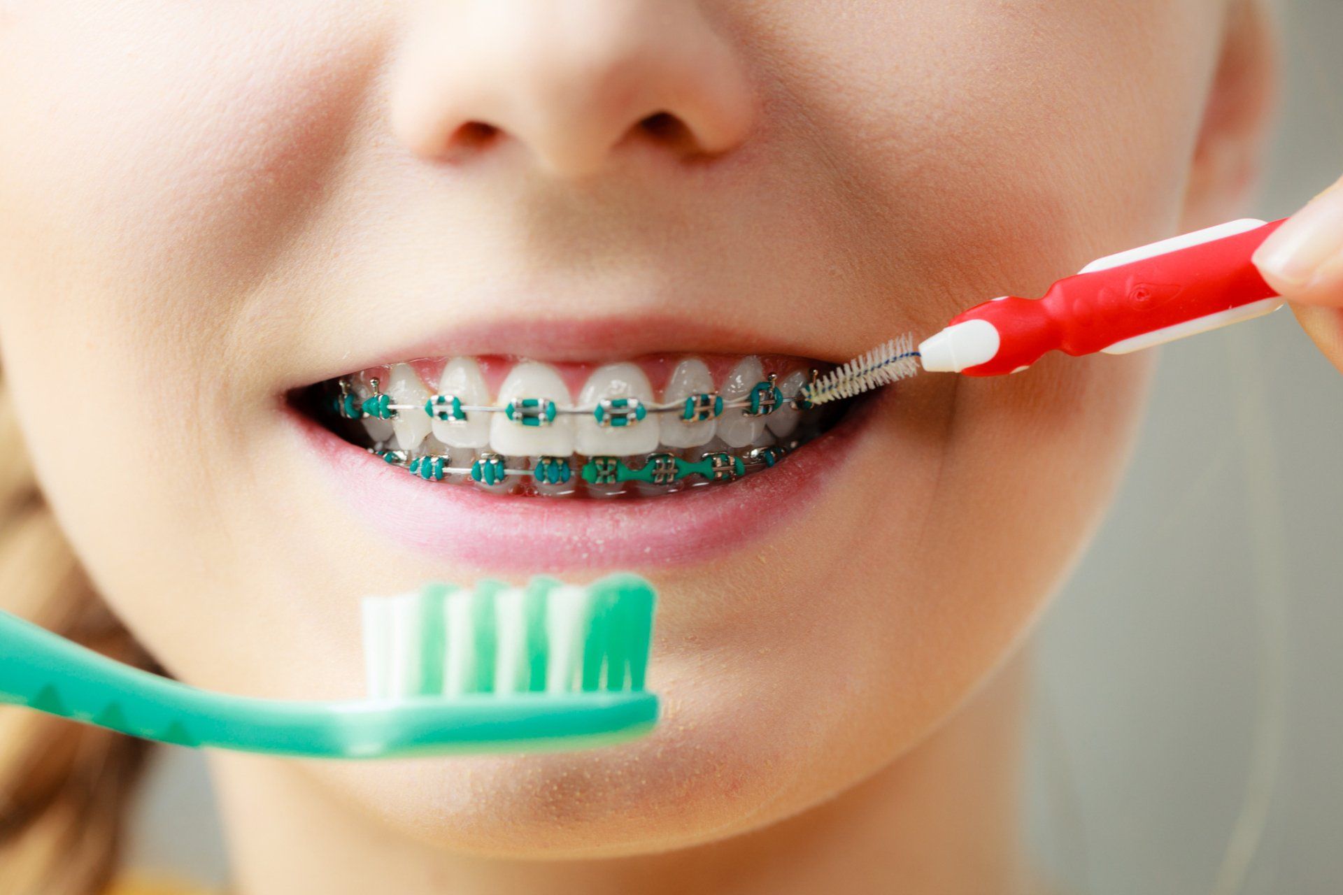 Orthodontic Care – Riverton, UT – Welton Orthodontics