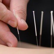 chinese acupuncture and acupuncturists in wimbledon 