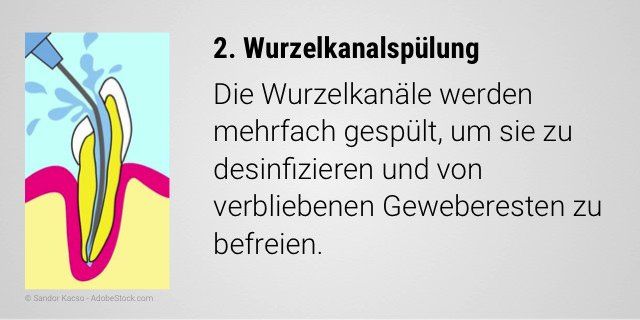 Desinfizierende Spülung der Wurzelkanäle