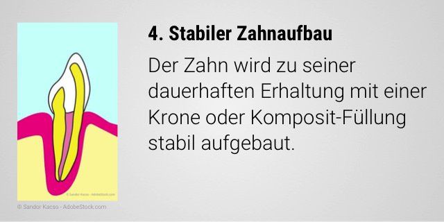 Stabiler Zahnaufbau mit einer Krone oder Komposit-Füllung nach der Wurzelbehandlung