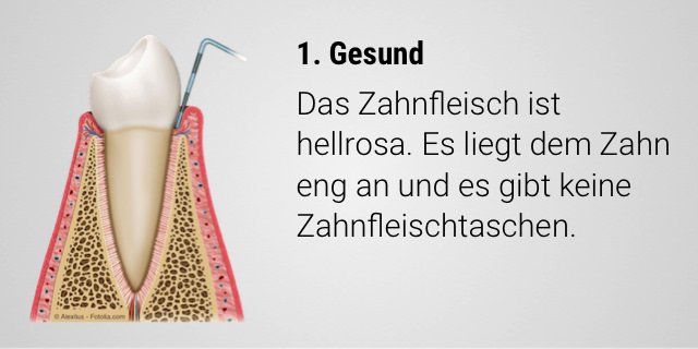Gesundes Zahnfleisch