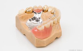 Mit Implantaten können festsitzende Zähne statt herausnehmbarer Teilprothesen eingesetzt werden Mit Implantaten können festsitzende Zähne statt herausnehmbarer Teilprothesen eingesetzt werden