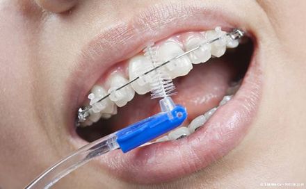 Ortho-Bürstchen für die Reinigung schwer zugänglicher Bereiche bei festen Zahnspangen Ortho-Bürstchen für die Reinigung schwer zugänglicher Bereiche bei festen Zahnspangen