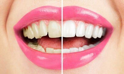 Before And After Of Teeth Whitening — Burnsville, MN — Centerpointe Dental Before And After Of Teeth Whitening — Burnsville, MN — Centerpointe Dental