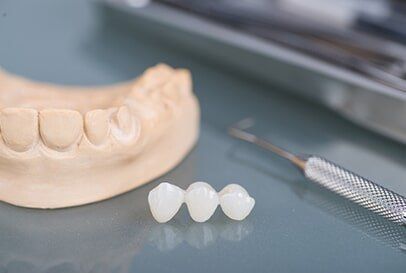Dental Bridges — Burnsville, MN — Centerpointe Dental Dental Bridges — Burnsville, MN — Centerpointe Dental