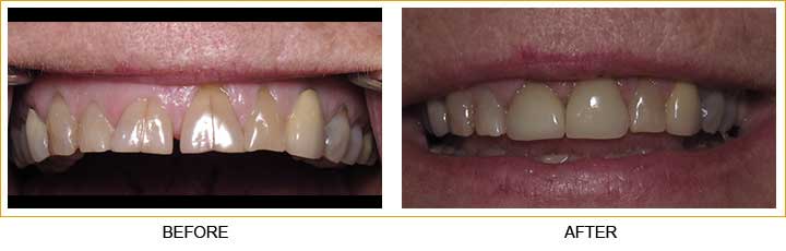Dental Crowns and Bridges in Athens - TLC Dental Wellness