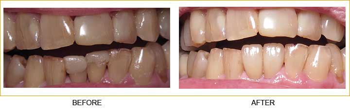 Dental Crowns and Bridges in Athens - TLC Dental Wellness