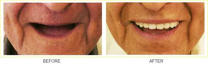 Dental Implant in Athens - TLC Dental Wellness