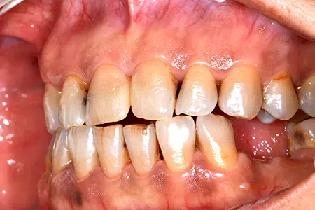 Gum Disease in Athens, Oconee - TLC Dental Wellness