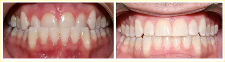 Orthodontics and Invisalign  in Athens & Oconee - TLC Dental Wellness