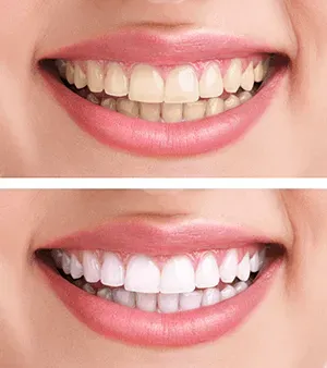 Teeth Whitening in Athens - TLC Dental Wellness